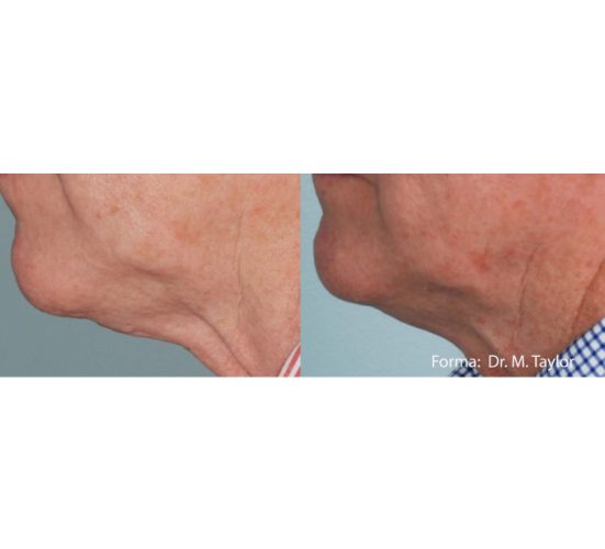 Old Male Face Before and After Getting Forma Skin Tightening treatments | Aspen Prime Med Spa in Hoboken, NJ