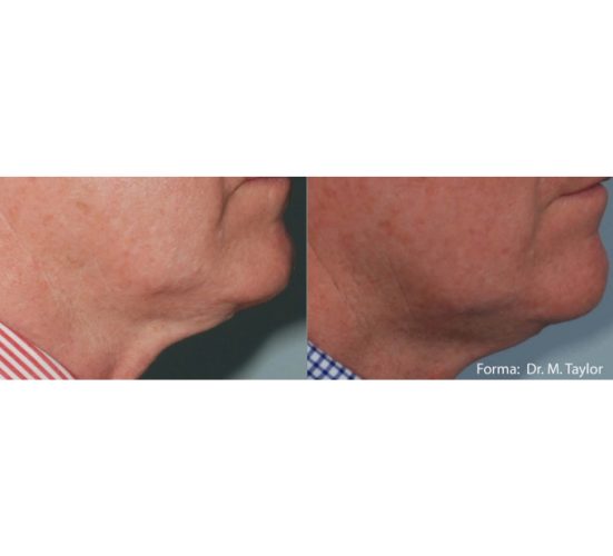 Old Male Face Before and After Getting Forma Skin Tightening treatments | Aspen Prime Med Spa in Hoboken, NJ