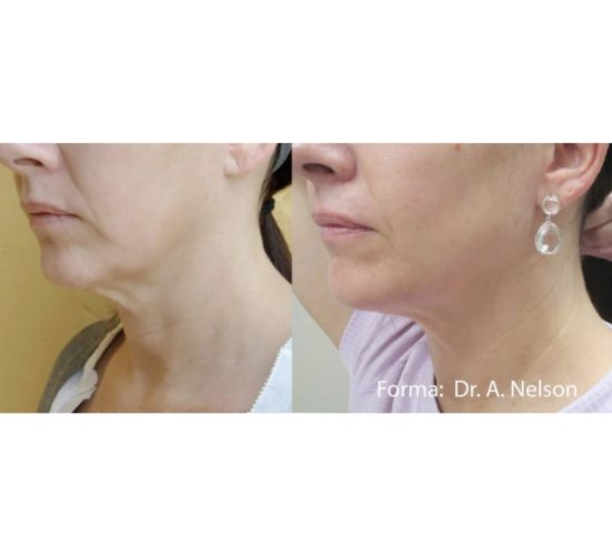 Old Female Face Before and After Getting Forma Skin Tightening treatments | Aspen Prime Med Spa in Hoboken, NJ