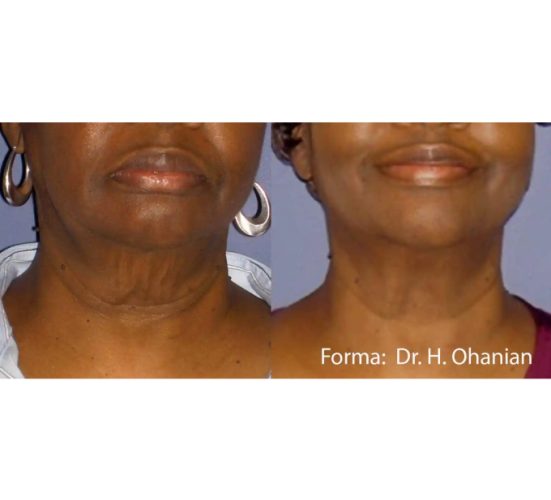 Young Female Face Before and After Getting Forma Skin Tightening treatments | Aspen Prime Med Spa in Hoboken, NJ