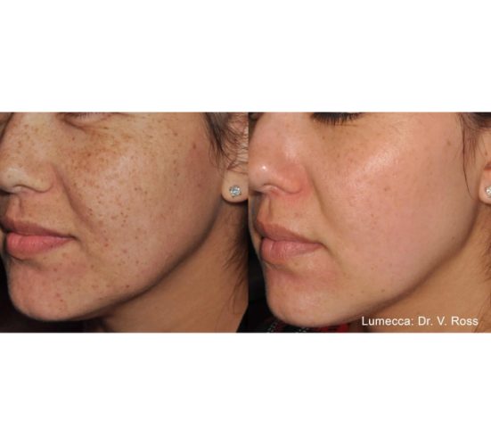 Young Female Face Before and After Getting Lumecca IPL Photofacial treatments | Aspen Prime Med Spa in Hoboken, NJ