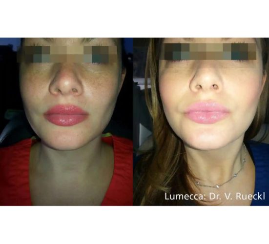 Young Female Face Before and After Getting Lumecca IPL Photofacial treatments | Aspen Prime Med Spa in Hoboken, NJ