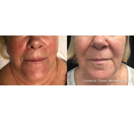 Old Female Face Before and After Getting Lumecca IPL Photofacial treatments | Aspen Prime Med Spa in Hoboken, NJ