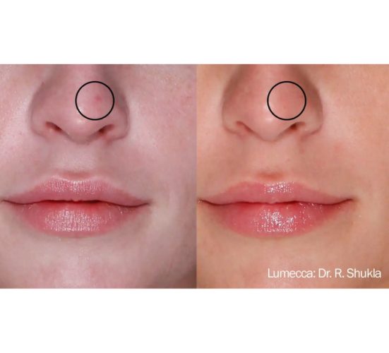 Young Female Nose Before and After Getting Lumecca IPL Photofacial treatments | Aspen Prime Med Spa in Hoboken, NJ