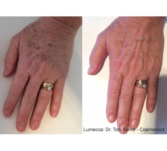 Old Female Hand Before and After Getting Lumecca IPL Photofacial treatments | Aspen Prime Med Spa in Hoboken, NJ