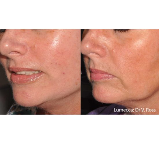 Old Female Before and After Getting Lumecca IPL Photofacial treatments | Aspen Prime Med Spa in Hoboken, NJ