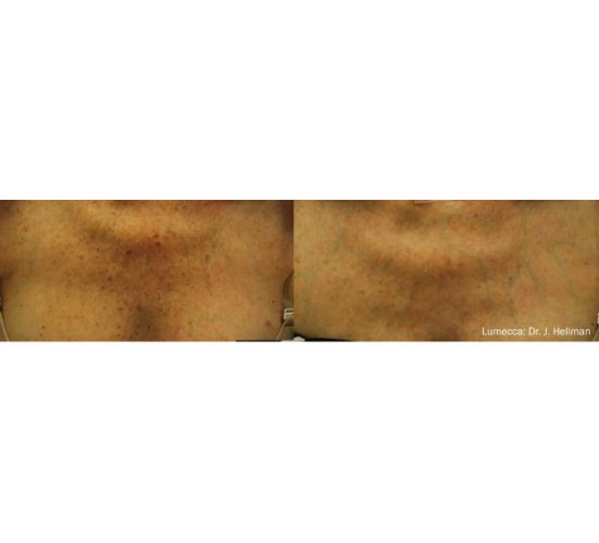 Optimas Lumecca Treatment Before and After Chest Photos | Aspen Prime MedSpa in Hoboken, NJ