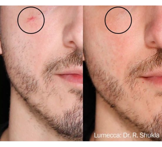 Young Male Before and After Getting Lumecca IPL Photofacial treatments | Aspen Prime Med Spa in Hoboken, NJ