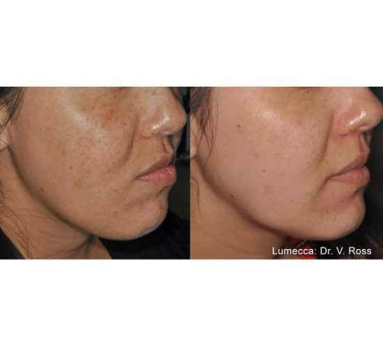 Young Female Before and After Getting Lumecca IPL Photofacial treatments | Aspen Prime Med Spa in Hoboken, NJ