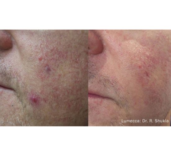 Old Male Before and After Getting Lumecca IPL Photofacial treatments | Aspen Prime Med Spa in Hoboken, NJ