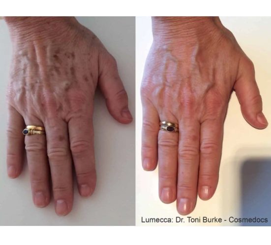 Old Female Hand Before and After Getting Lumecca IPL Photofacial treatments | Aspen Prime Med Spa in Hoboken, NJ