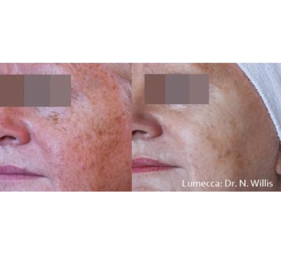 Old Female Before and After Getting Lumecca IPL Photofacial treatments | Aspen Prime Med Spa in Hoboken, NJ