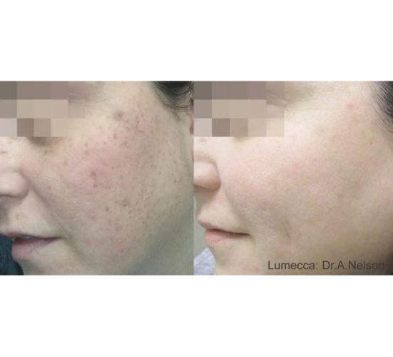 Young Female Before and After Getting Lumecca IPL Photofacial treatments | Aspen Prime Med Spa in Hoboken, NJ