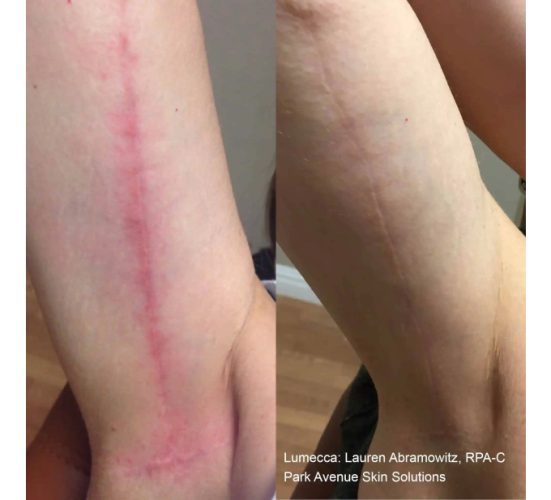 Young Female Hand Before and After Getting Lumecca IPL Photofacial treatments | Aspen Prime Med Spa in Hoboken, NJ