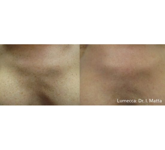 Old Female Chest Before and After Getting Lumecca IPL Photofacial treatments | Aspen Prime Med Spa in Hoboken, NJ