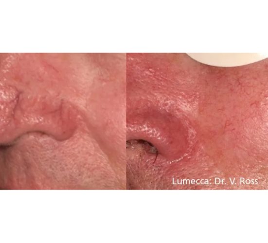 Old Female Nose Before and After Getting Lumecca IPL Photofacial treatments | Aspen Prime Med Spa in Hoboken, NJ