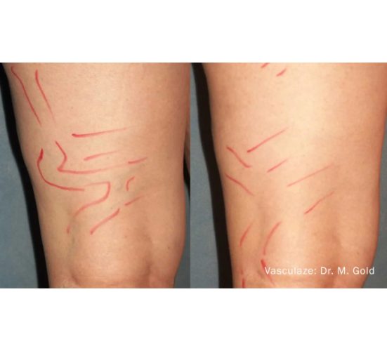 Optimas Vasculaze Treatment Before and After Leg Photos | Aspen Prime MedSpa in Hoboken, NJ